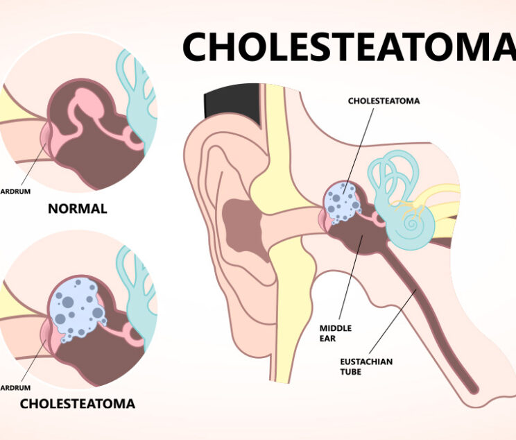 Ear-cholesteatoma