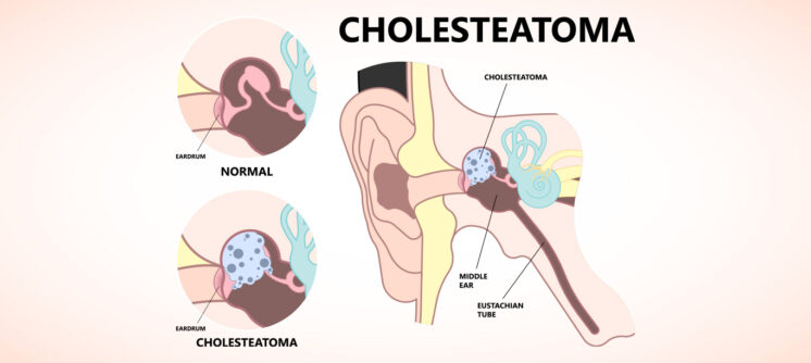 Ear-cholesteatoma